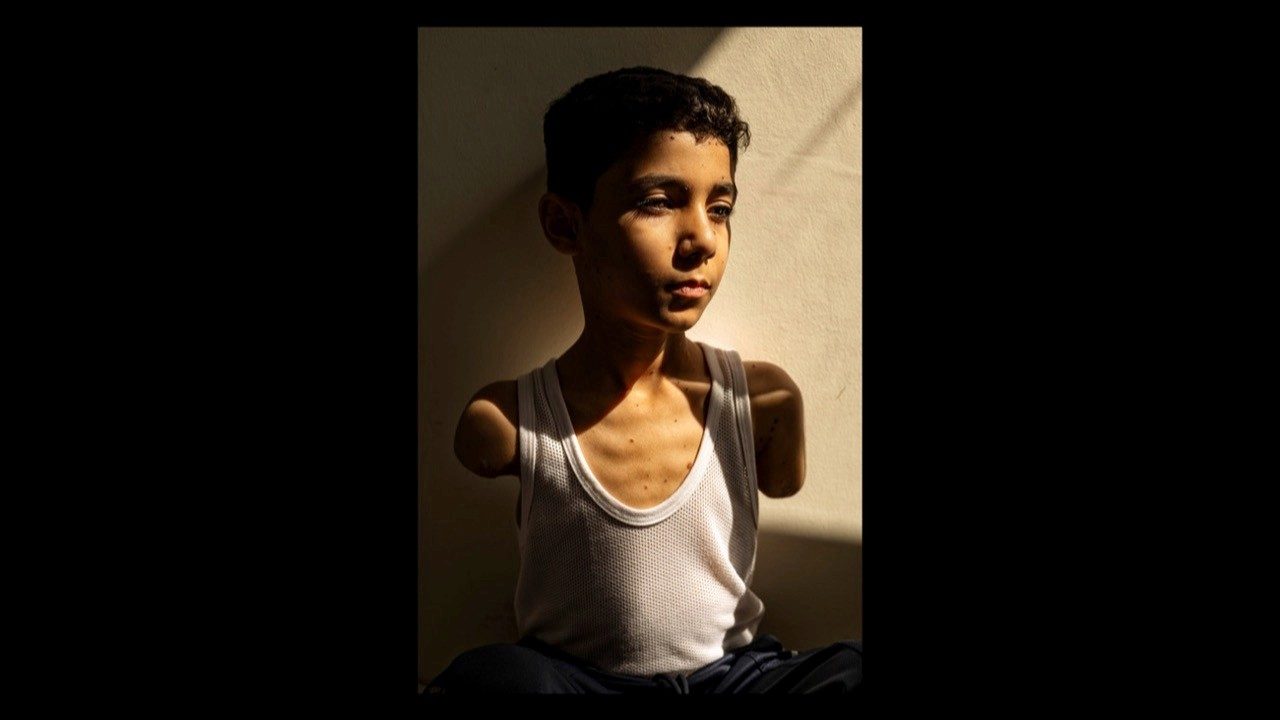 World Press Photo: Premiada la foto de un niño amputado de Gaza